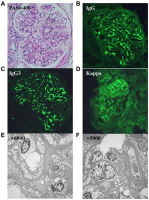 Promising response of proliferative glomerulonephritis with monoclonal IgG deposits to low-dose daratumumab: a case report